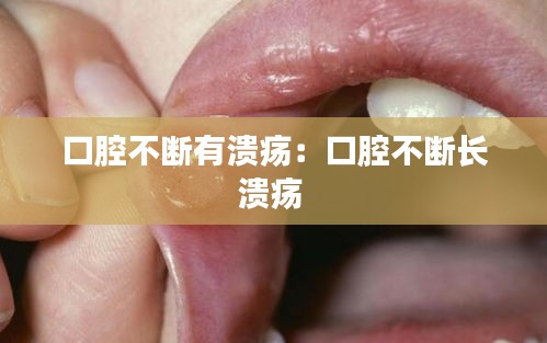 口腔不断有溃疡：口腔不断长溃疡 